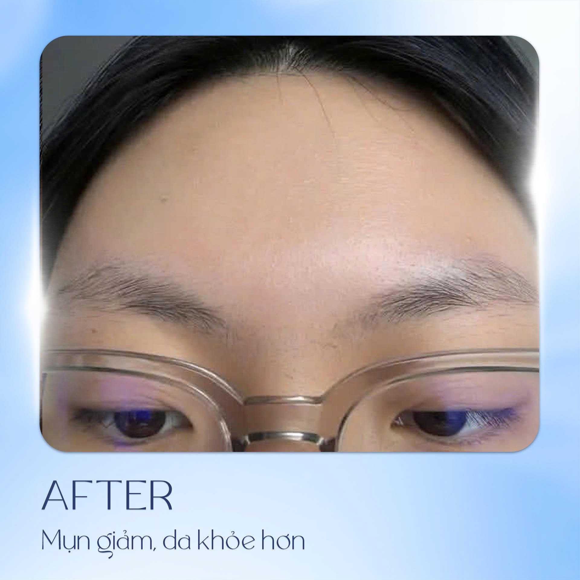 Khách hàng mờ thâm nám